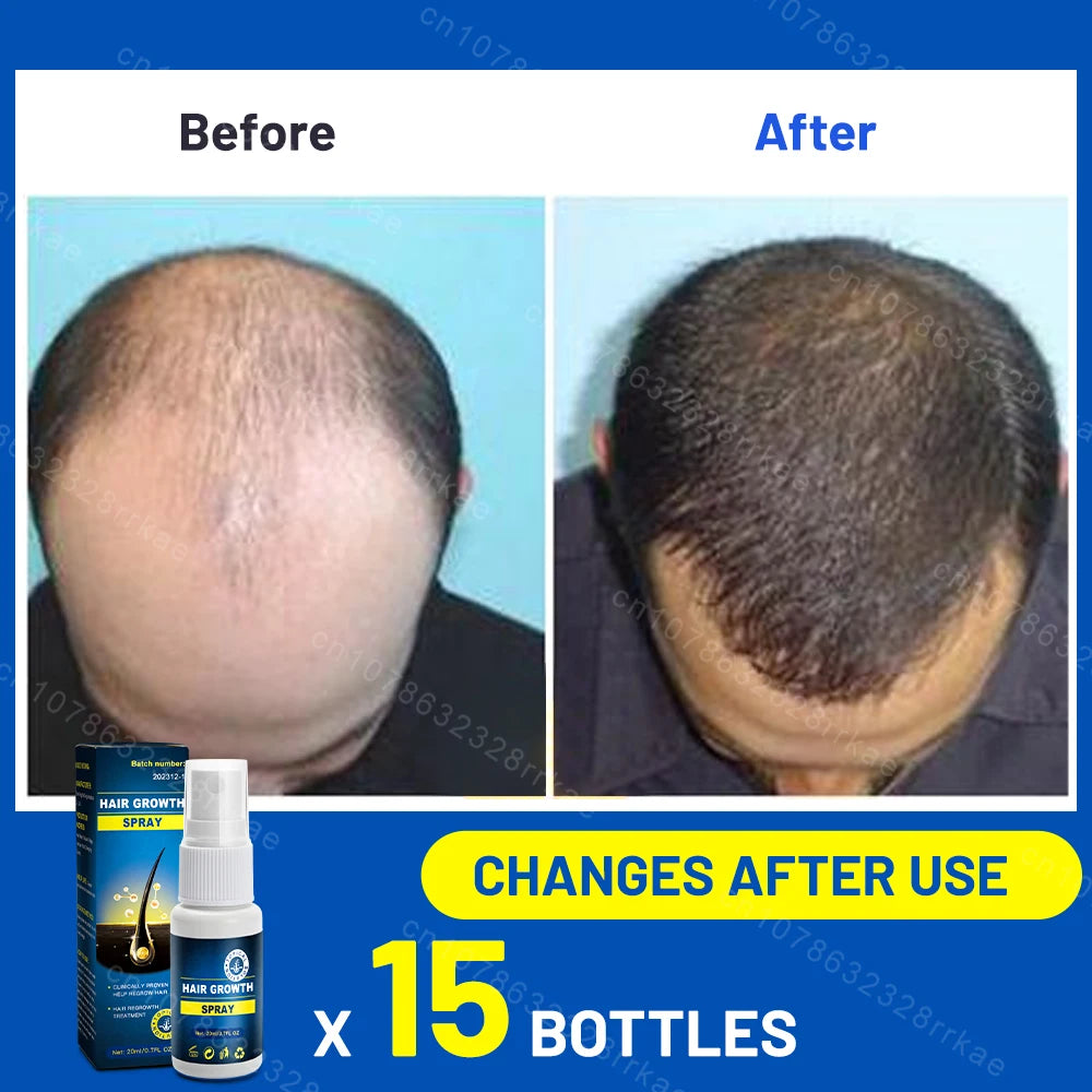 Hair growth products for men and women anti-hair loss rapid hair growth effective repair of baldness symptoms of hair loss